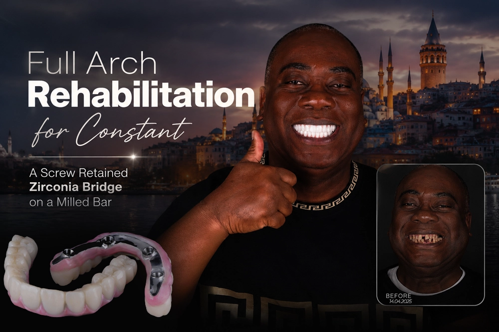 Implant Supported Zirconia Bridge: Constant’s Case