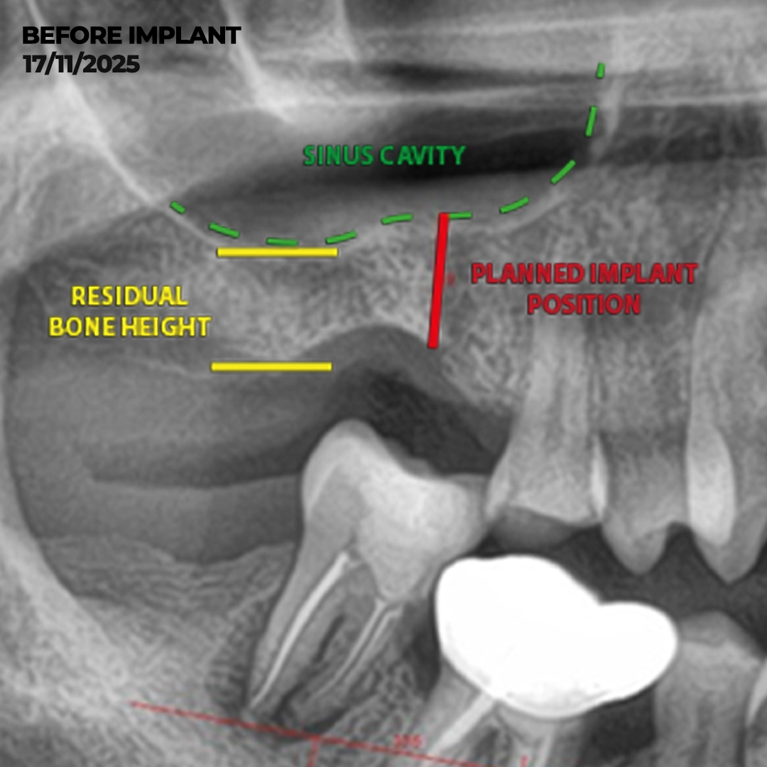 Preparing the Surgical Site Closed Sinus Lift, Complicated Extractions and Alveoplasty