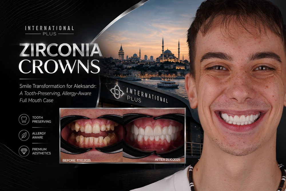 Zirconia Crowns Smile Transformation: Aleksandr’s Case