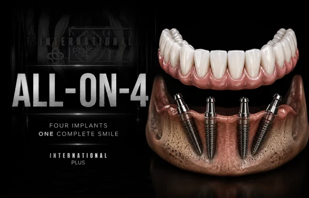 All on 4 Dental Implants: How Four Implants Rebuild a Full Arch