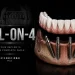 All on 4 Dental Implants How Four Implants Rebuild a Full Arch