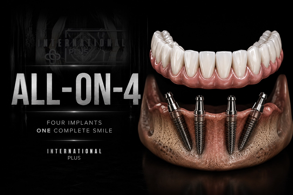 All on 4 Dental Implants: How Four Implants Rebuild a Full Arch
