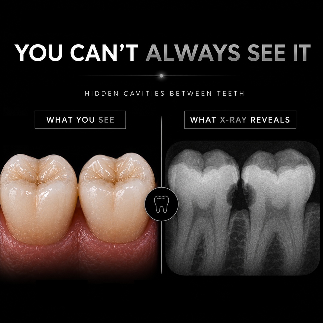 Are Cavities Contagious
