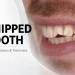 Chipped Tooth Repair Options and When to See a Dentist