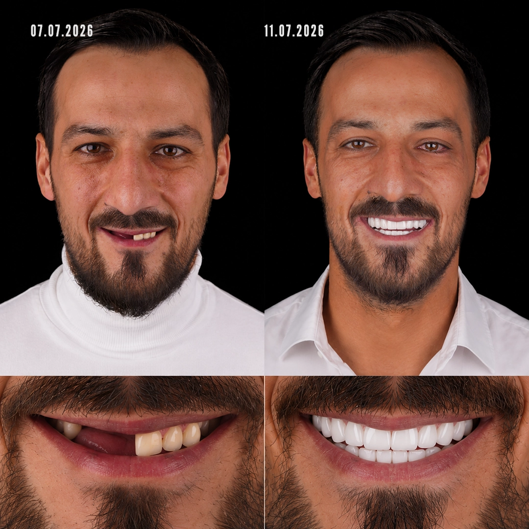 Dental bridge versus implant versus denture which suits a missing tooth