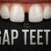 Gap Teeth (Diastema) Causes, Treatment Options and Whether to Close the Gap