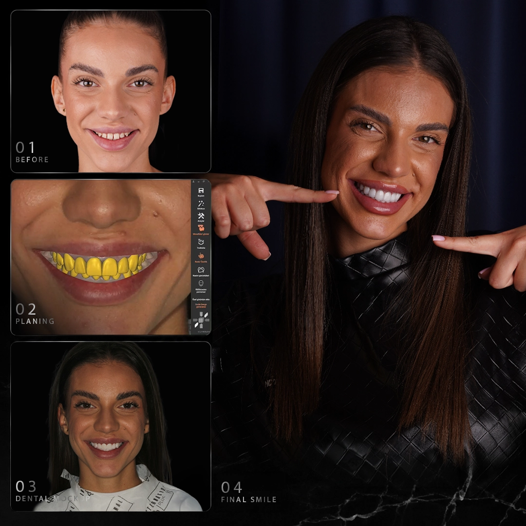 How Are Colour, Shape and Symmetry Planned Before Veneers