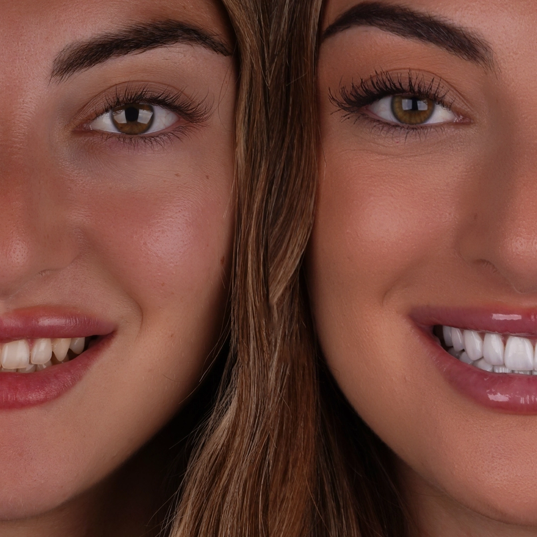 How Long Do Emax Veneers Last and How Durable Are They