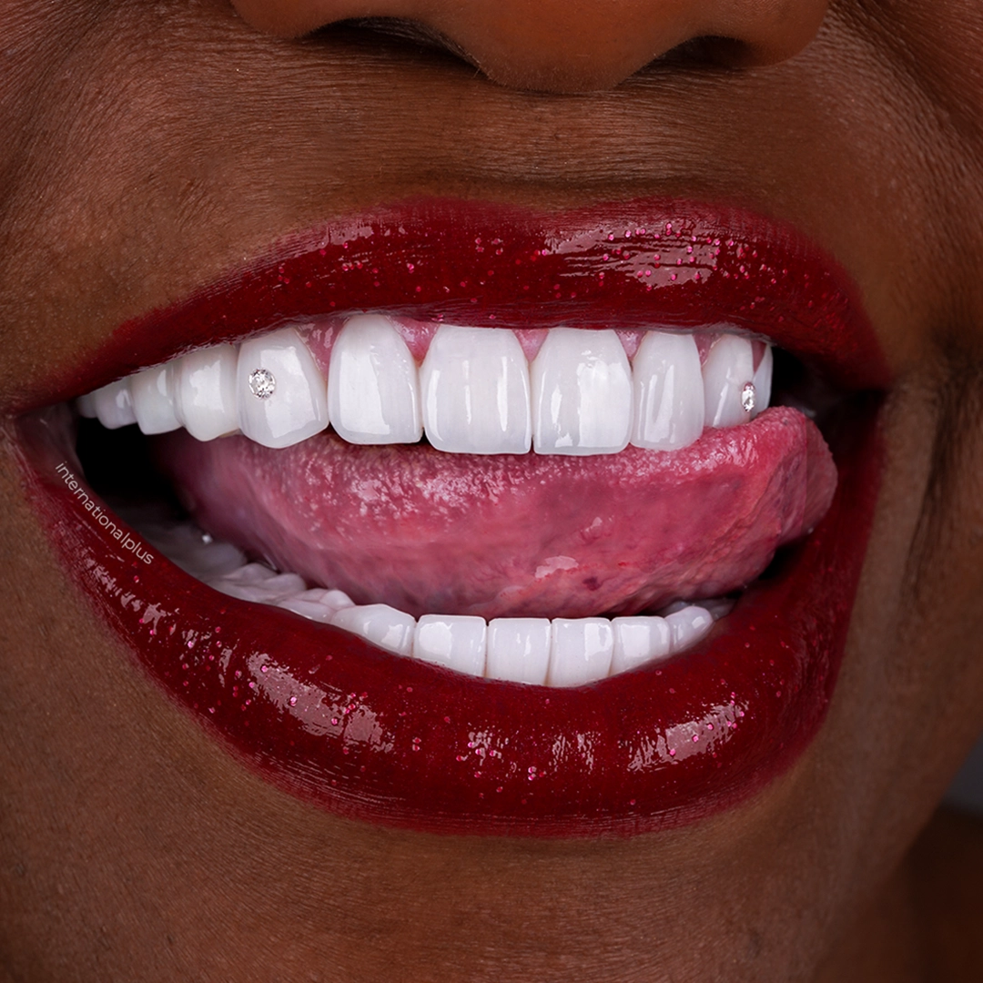How Were the 26 Zirconium Units and the Five Screw Retained Units Built