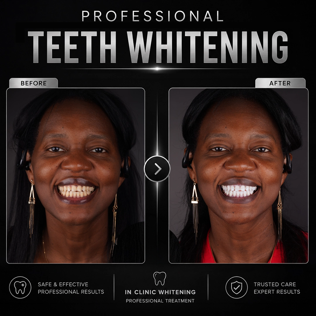 How to Use Teeth Whitening Strips Safely, Step by Step