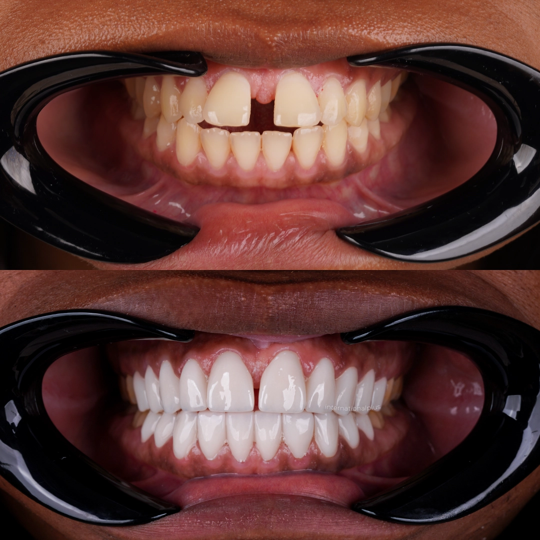 Keeping the Diastema and Correcting the Gum Line
