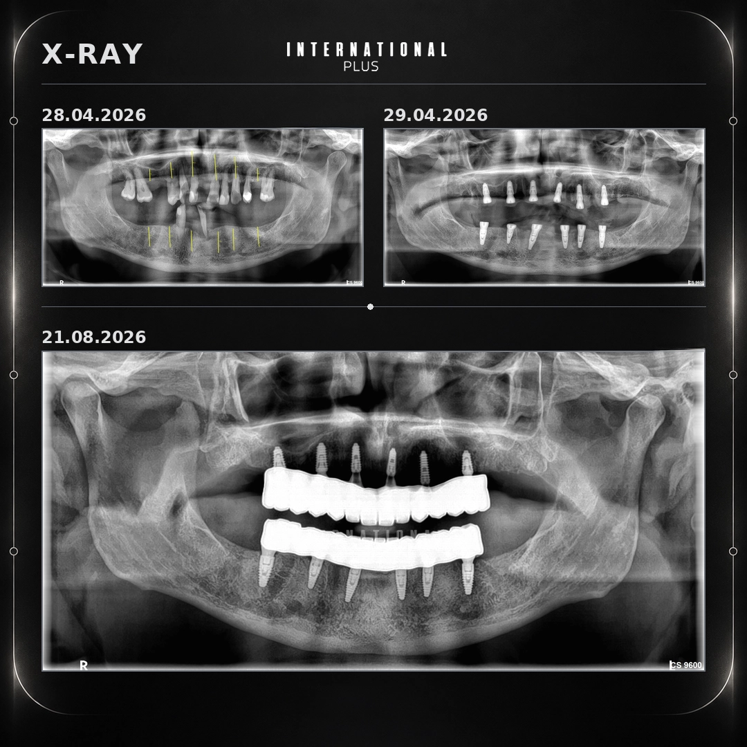 Megagen in the Upper Jaw, BEGO in the Lower