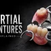 Partial Dentures Explained Types, Fitting and How They Replace Missing Teeth
