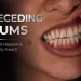 Receding Gums What Causes Recession and How to Fix It