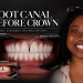 Root Canal Before Crown How Three Endodontic Treatments Fitted Inside a 20 Unit Zirconia Rehabilitation