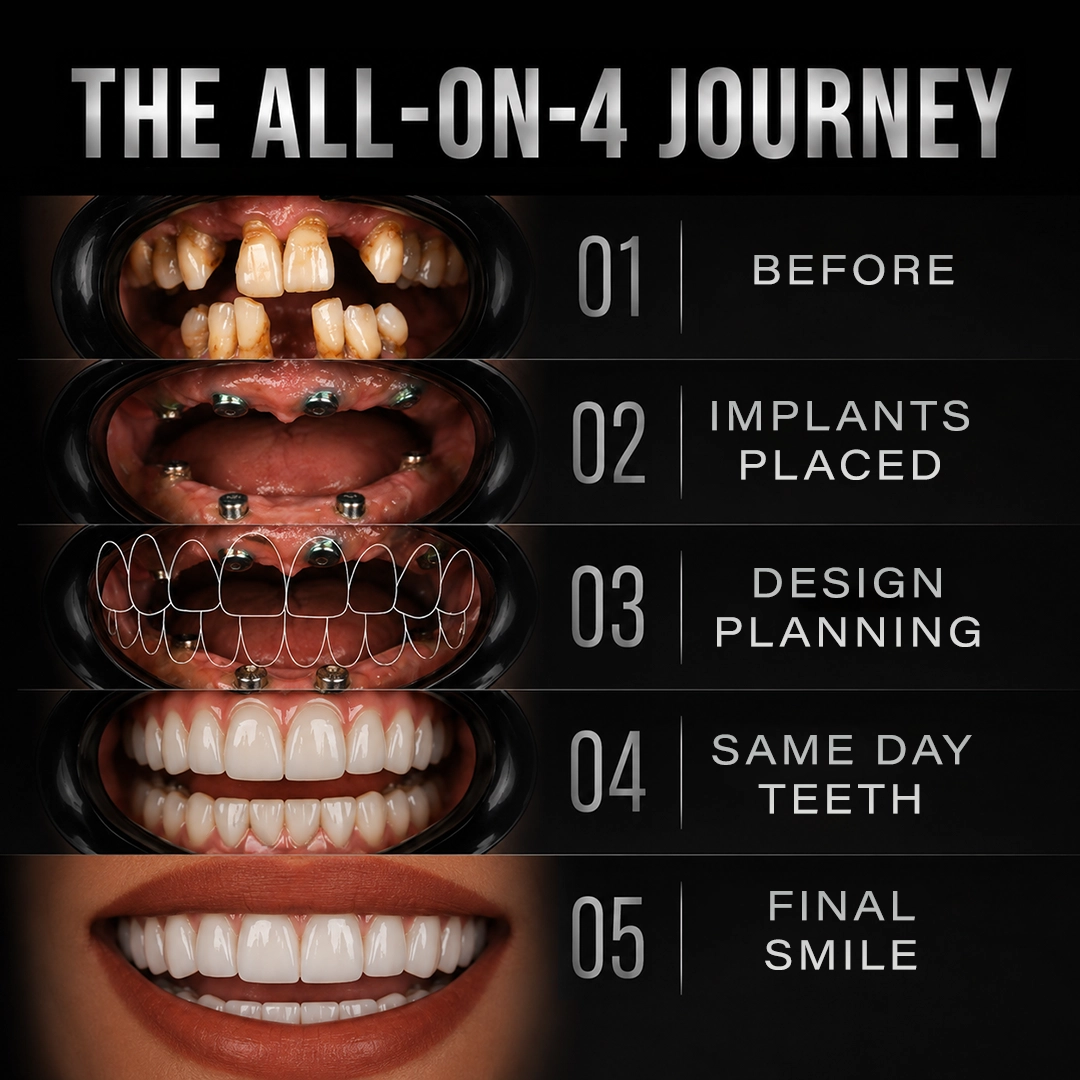 Same Day Teeth How Immediate Loading Works