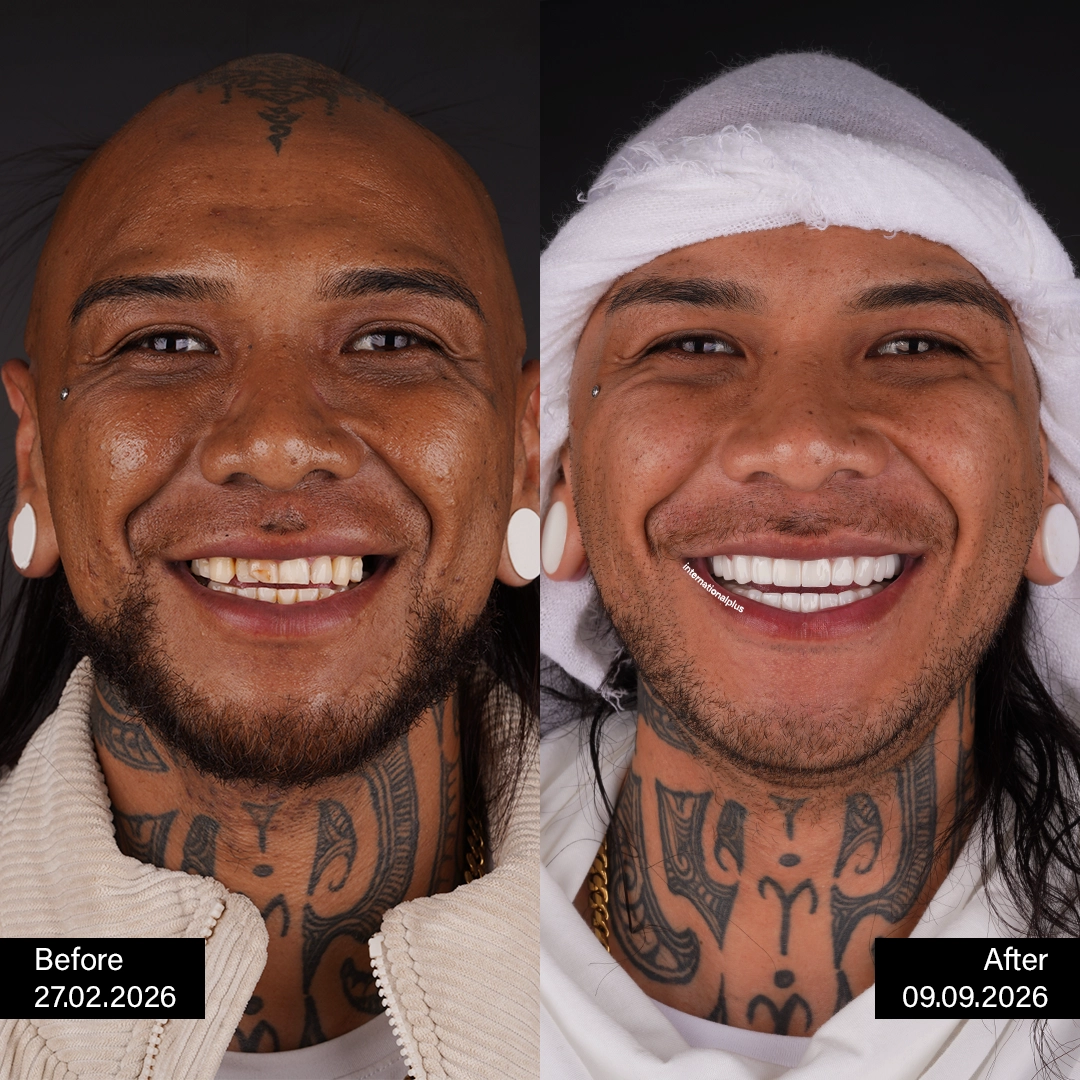 Twenty Five Zirconia Units, Including a Bridge