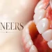 Veneers Before and After What Actually Changes and How to Read the Results