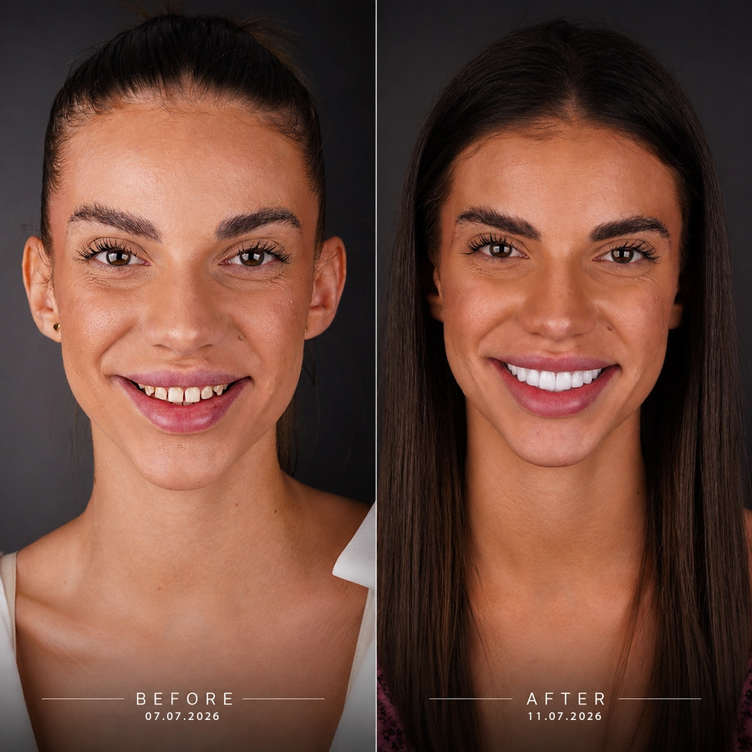 What Affects Your Veneers Before and After Result
