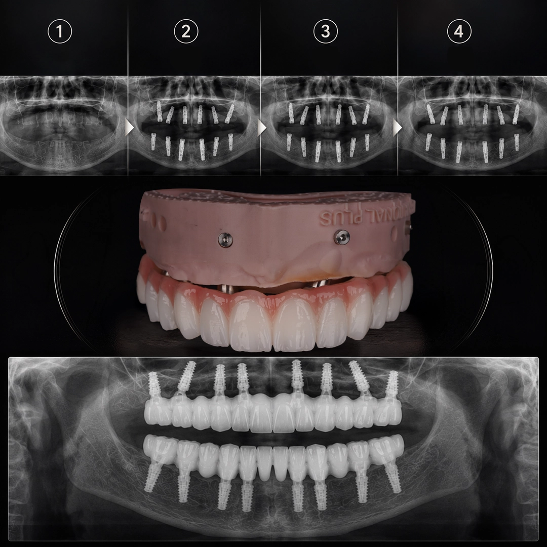 What Are Screwless Dental Implants
