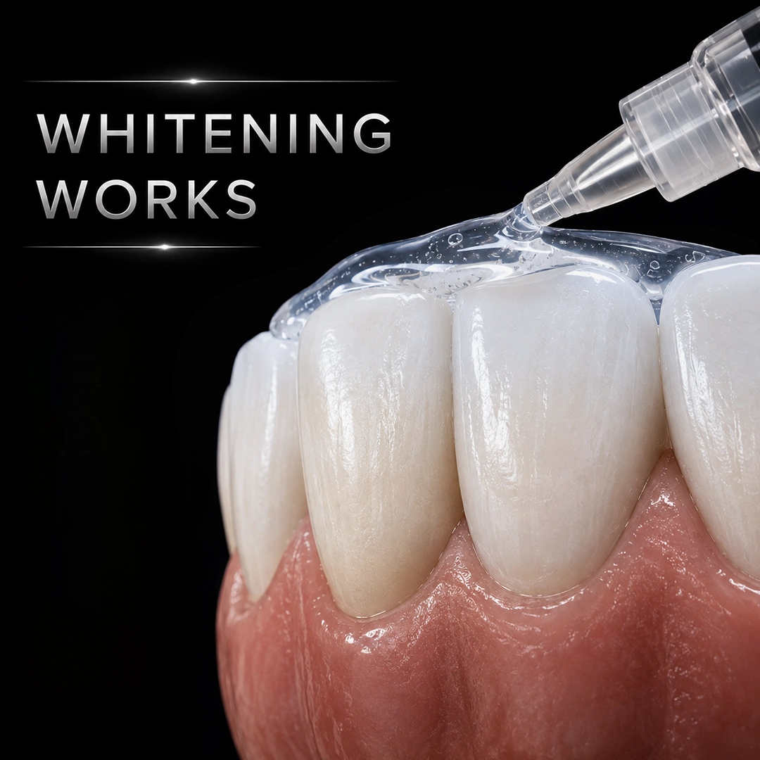 What Are Teeth Whitening Strips and How Do They Work