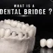 What Is a Dental Bridge and How Does It Fill the Gap of a Missing Tooth