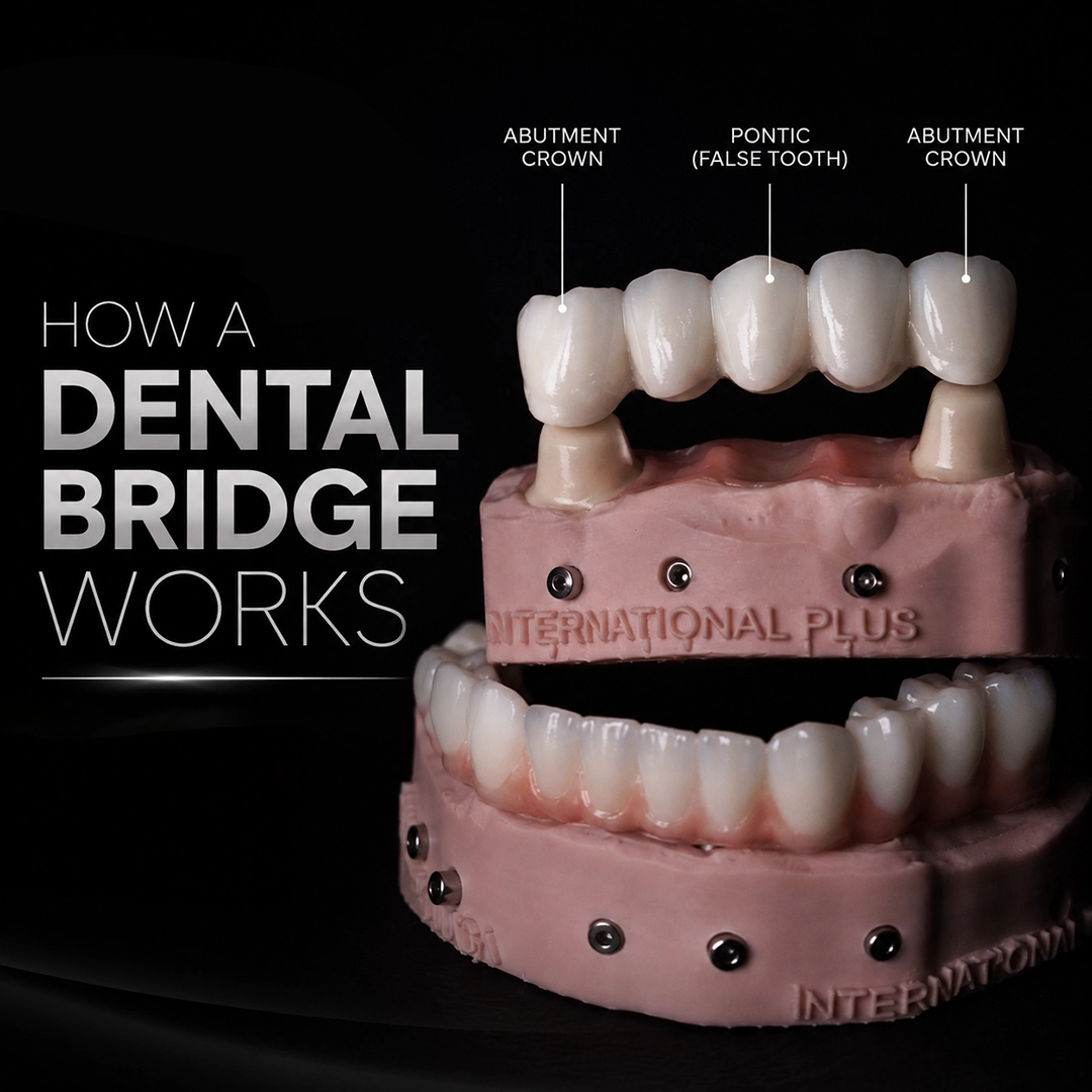 What is a dental bridge and how does it work