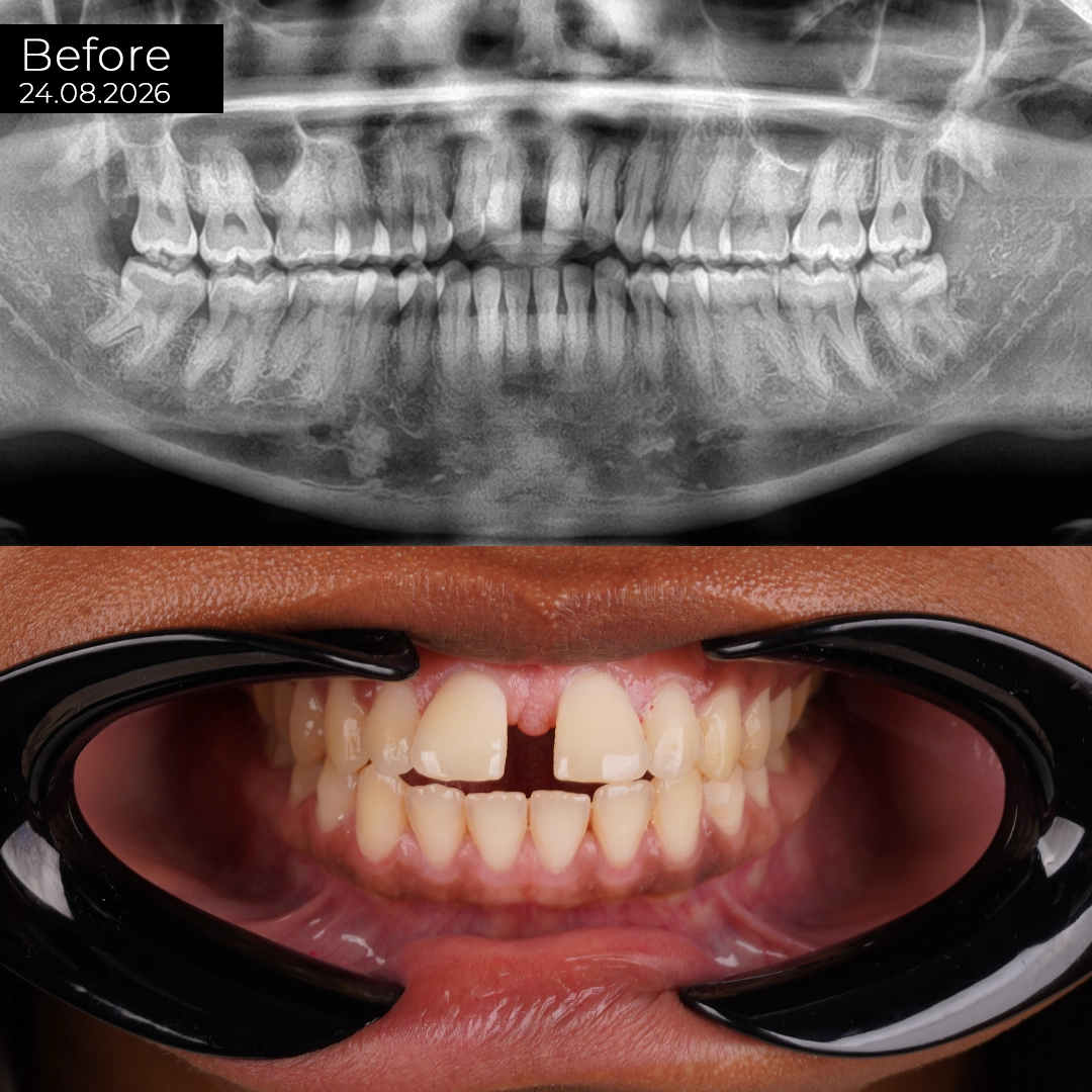 Why Endodontic Status Is Checked Before Any Crown Is Planned