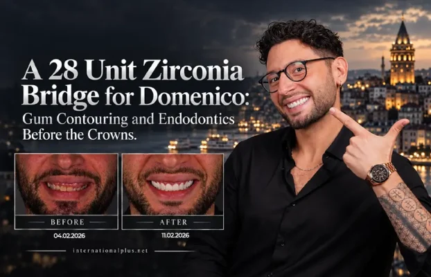 A 28 Unit Zirconia Bridge for Domenico: Gum Contouring and Endodontics Before the Crowns