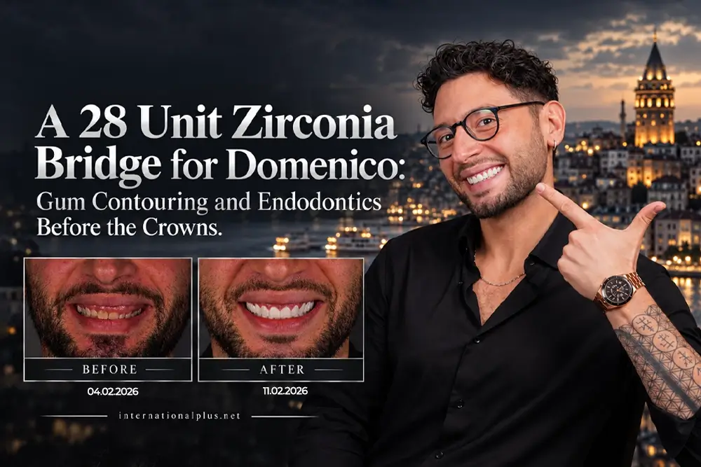 A 28 Unit Zirconia Bridge for Domenico: Gum Contouring and Endodontics Before the Crowns