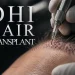 DHI Hair Transplant What the Choi Pen Changes and What It Does Not
