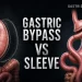 Gastric Bypass vs Sleeve A Structured Comparison of Two Operations