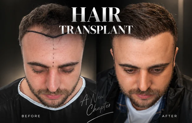 Hair Transplant Before and After: What the Timeline Really Looks Like