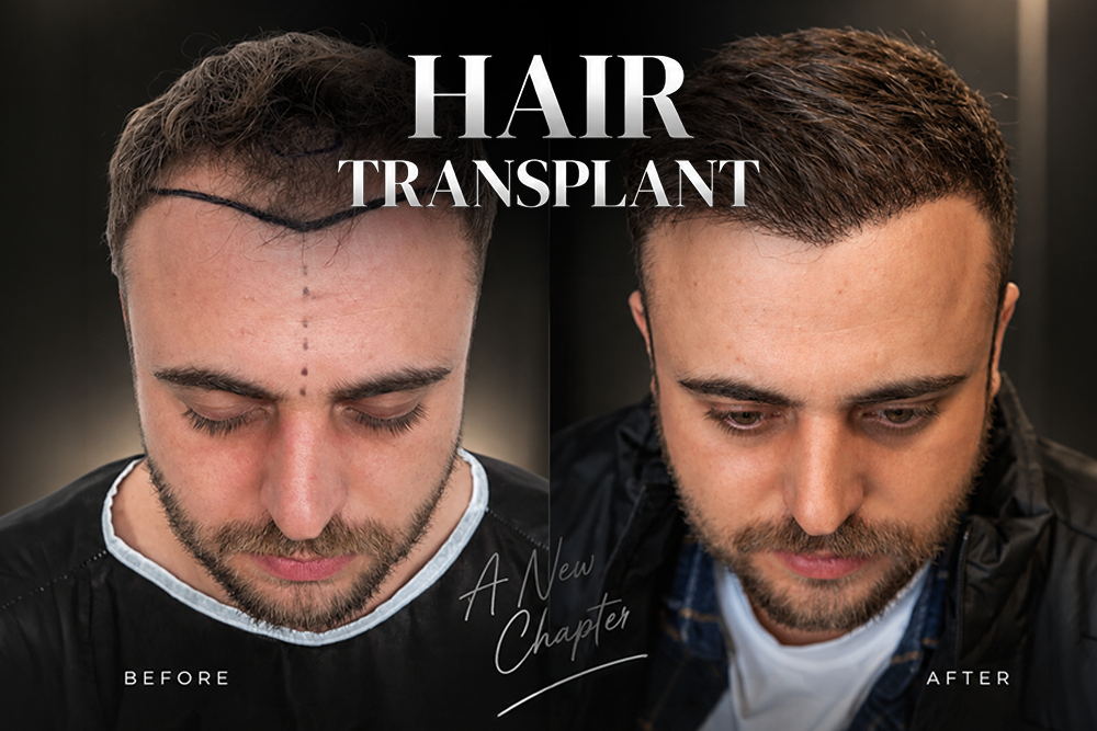 Hair Transplant Before and After: What the Timeline Really Looks Like