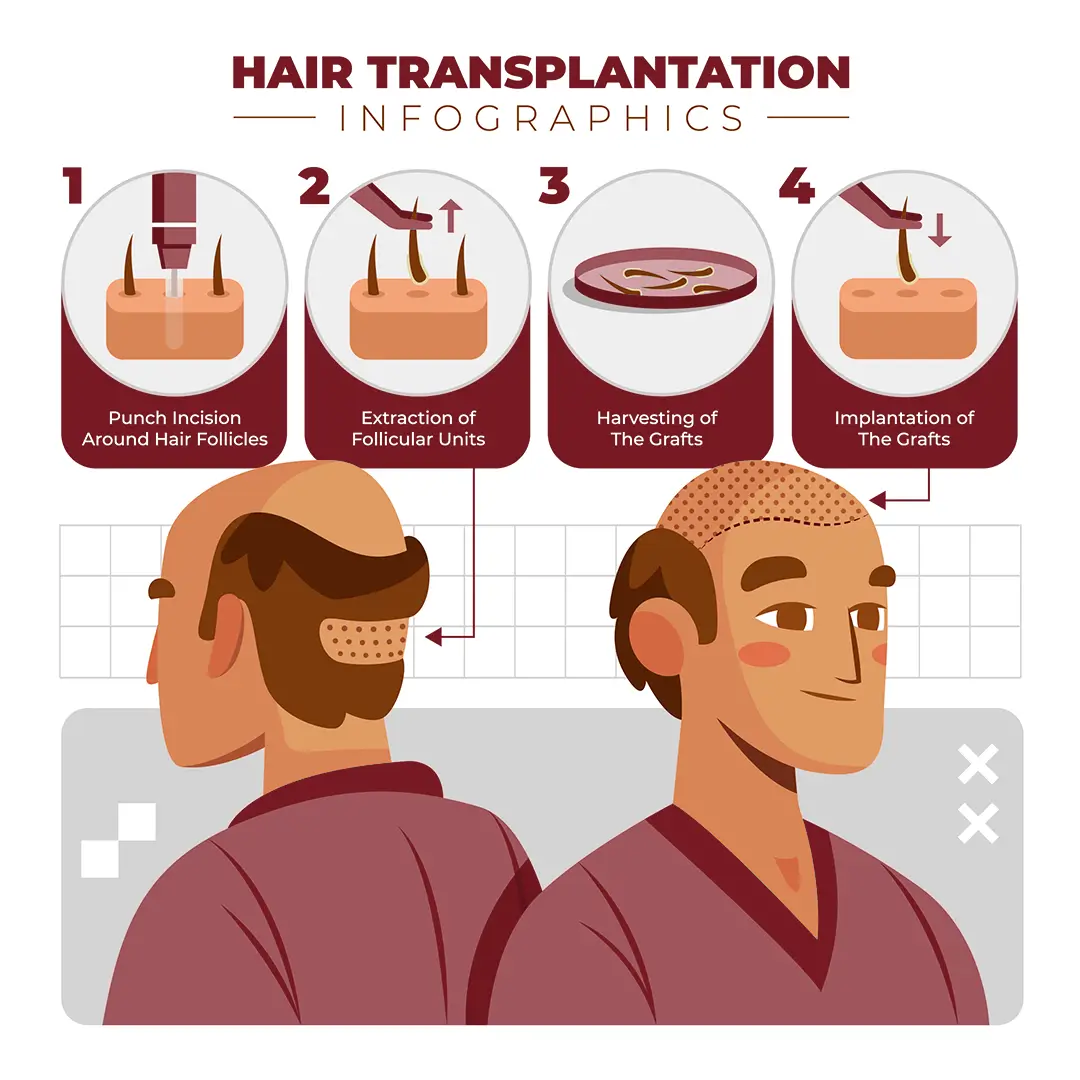 How Does Technique Change FUE Hair Transplant Cost