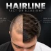Steve Carell Hair Transplant Where the Theory Comes From