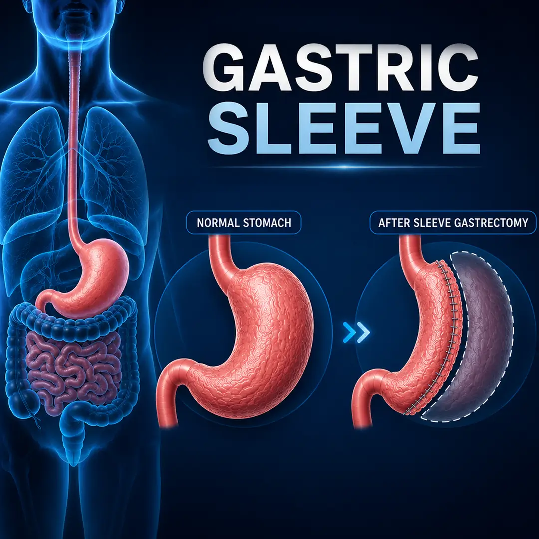 What Determines Gastric Sleeve Cost in Practice