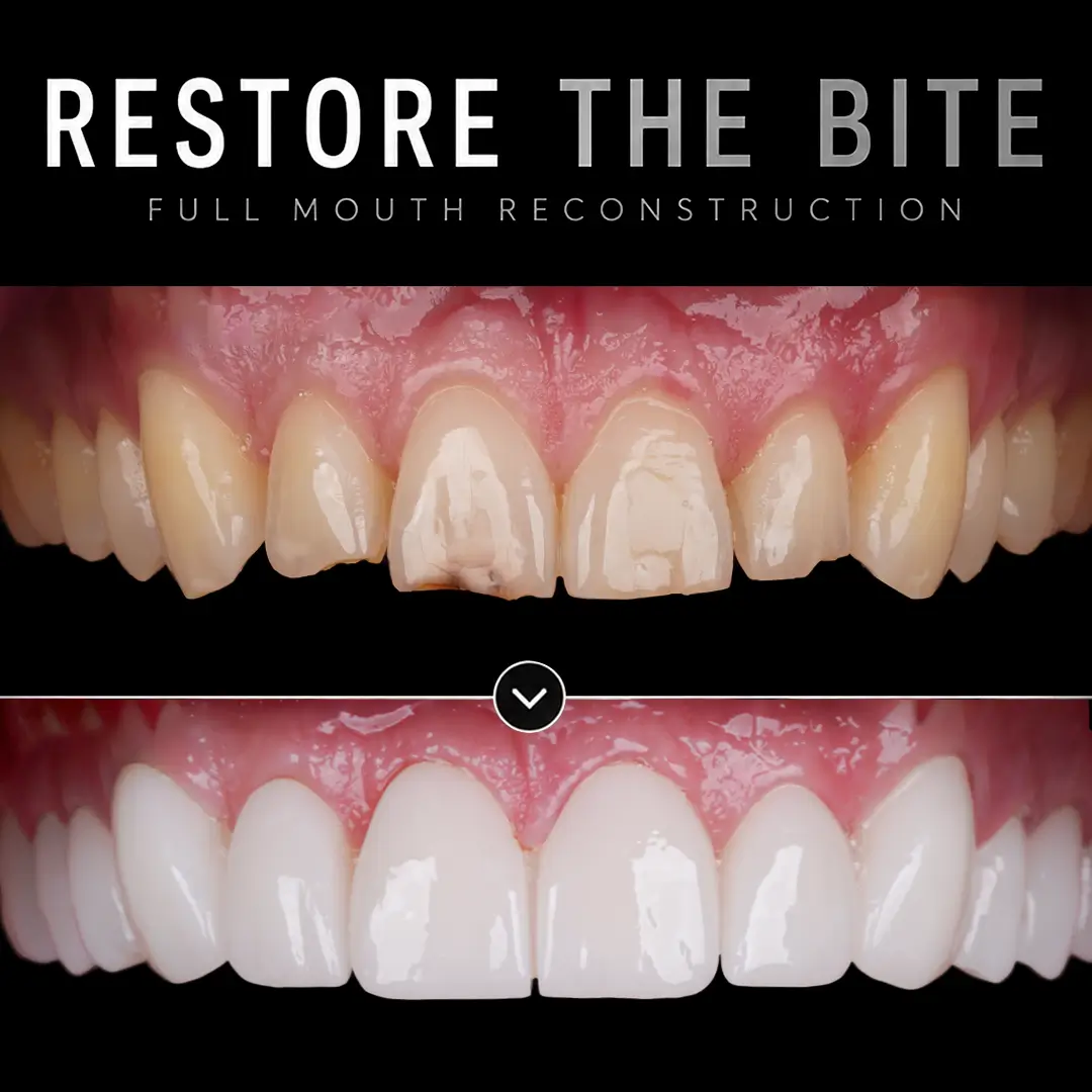 What Is Teeth Grinding (Bruxism)