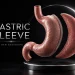 What Is a Gastric Sleeve The Procedure, the Follow-Up and the Long View