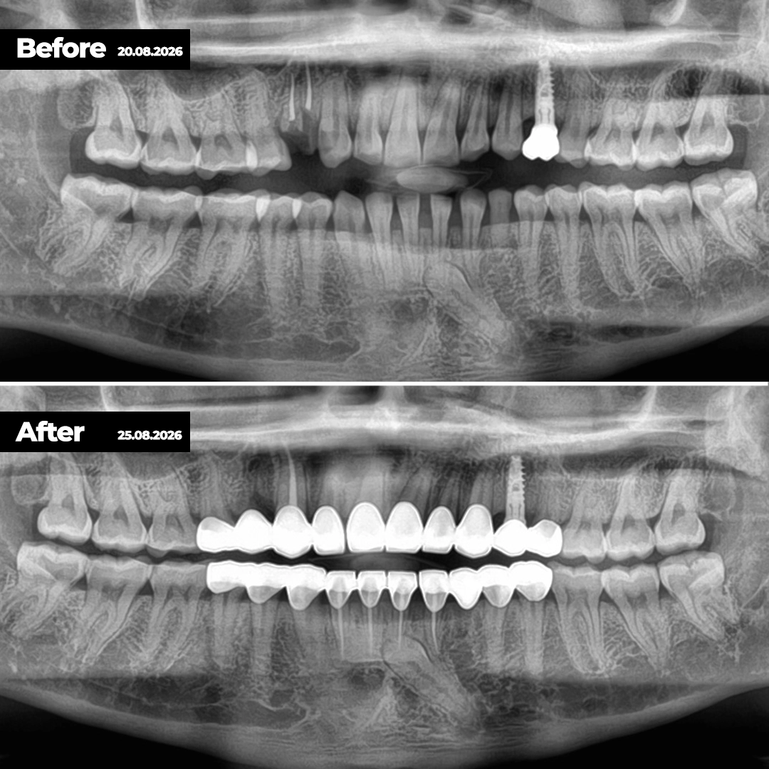 What Retained Baby Teeth Mean in an Adult Mouth