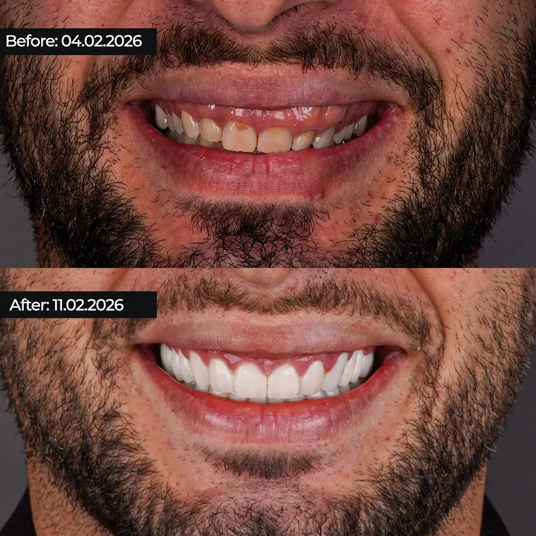 Why Gum Contouring Came Before the Crowns